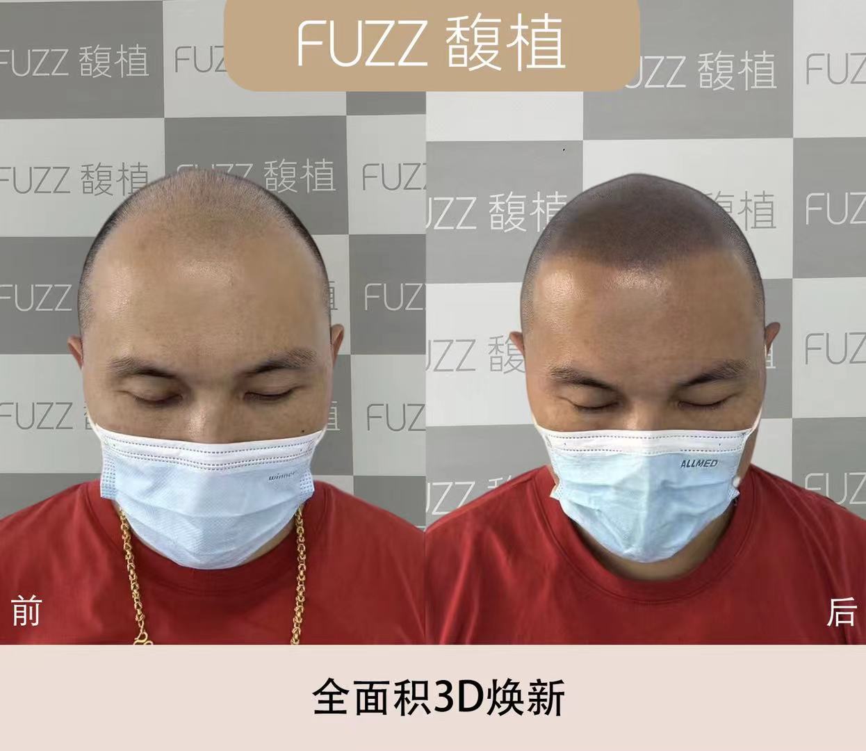 纹发培训