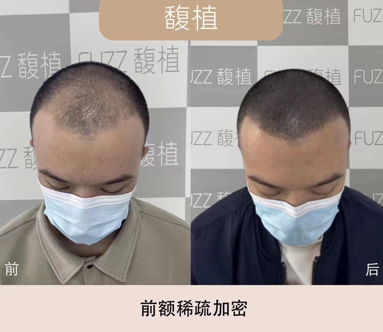 纹发效果